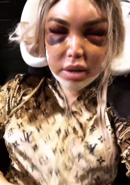 'Ken Bebek' Rodrigo Alves estetik sonrası halini takipçileriyle paylaştı! - Resim: 4