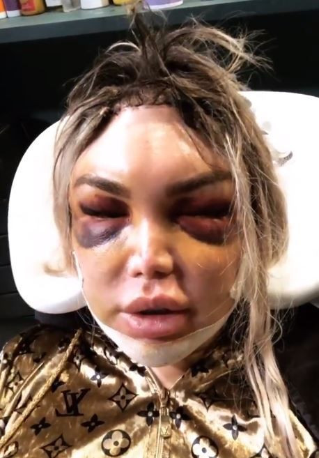 'Ken Bebek' Rodrigo Alves estetik sonrası halini takipçileriyle paylaştı! - Resim: 2