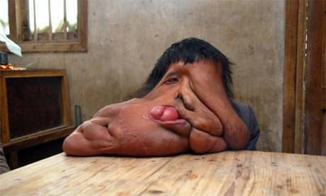 Dünyanın en garip hastalıkları - Resim: 3