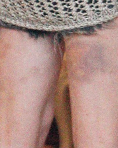 Ünlü güzelin her tarafı mosmor!  - Resim: 2