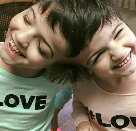 Bu halde dünyaya geldiler 'benzersiz ikizlere' bakın ölene kadar... - Resim: 2