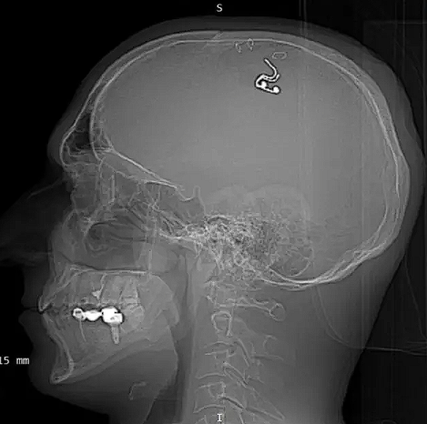 Rüyalarını kontrol etmek isteyen adam kafatasını matkapla deldi sonra da... - Resim: 0