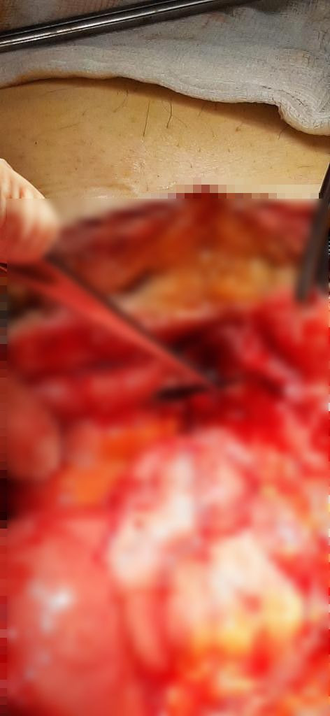 Karın ağrısı şikayetiyle gitti içinden çıkanlar doktoru dehşete düşürdü ekmekle birlikte yutmuş - Resim: 3