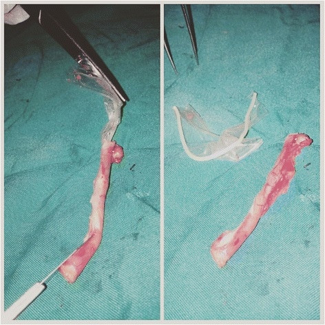 6 ay boyunca öksürük ateş dinmedi akciğerinden prezervatif çıktı! - Resim: 4