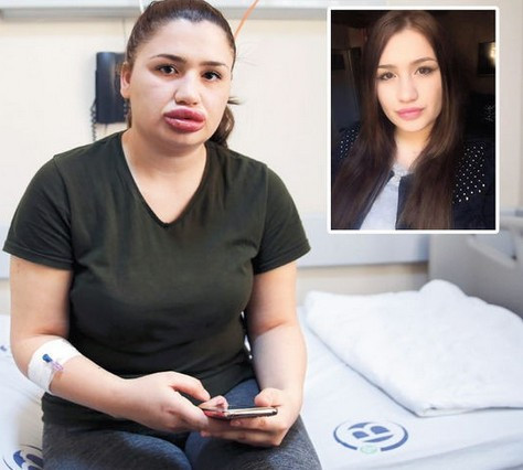 Silikon faciasında bomba gelişme dudak dolgusu yapan kuaför... - Resim: 2