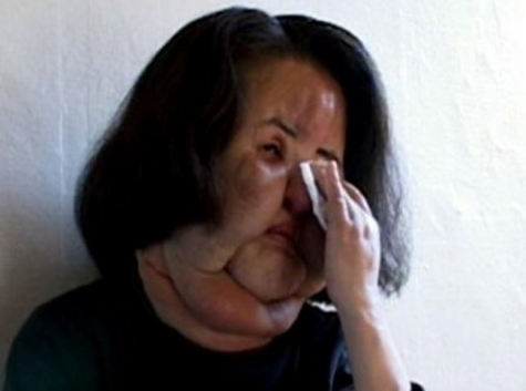 Yüzüne yemeklik yağ enjekte edince...  - Resim: 1