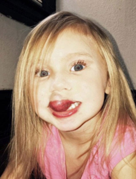 Küçük kızın dudağı morardı kanser çıktı... - Resim: 2