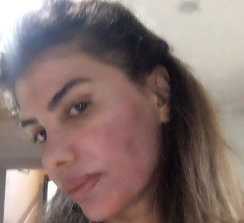 Şarkıcı Hatice'nin yüzü yandı son halini görenler tanımakta güçlük çekti - Resim: 4