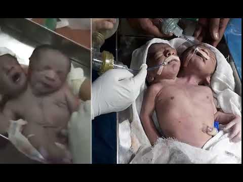 Akıllara durgunluk veren doğum 'İki baş tek benden' - Resim: 3