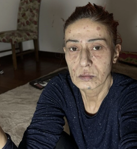 Yüzünde yanıklar oluşmuştu! Yıldız Tilbe yaşadığı olayla ilgili konuştu - Resim: 2