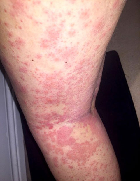 Epilasyondan tahriş oldu sandı kanser çıktı! - Resim: 2