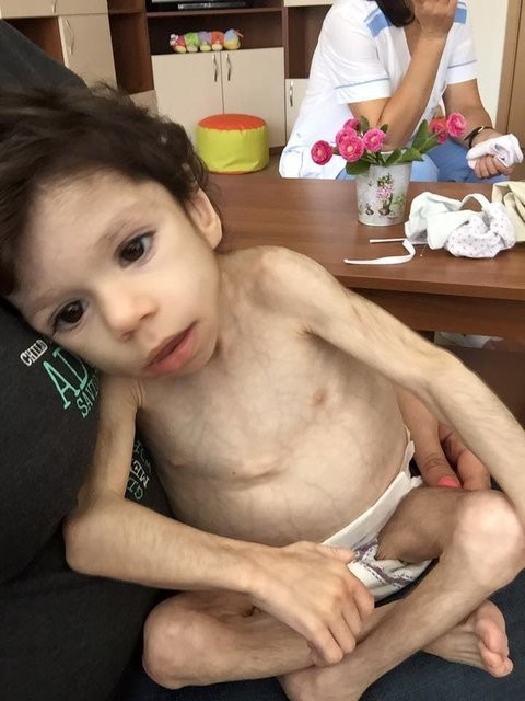 İskelet çocuğun inanılmaz değişimi ölümden döndü - Resim: 1