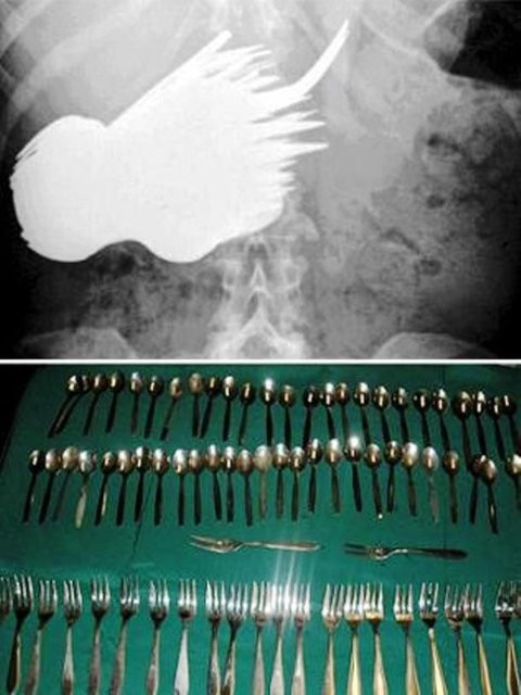 Midesinden öyle şeyler çıktı ki... - Resim: 2