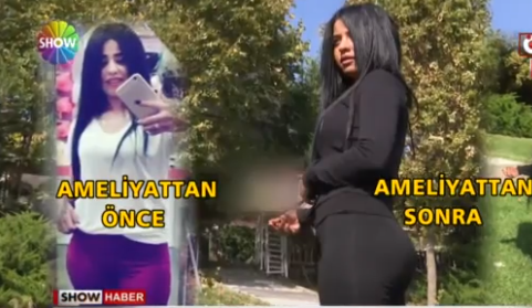 Brezilya kalçası yaptırmak için ameliyat oldu sonuç şoke etti - Resim: 1