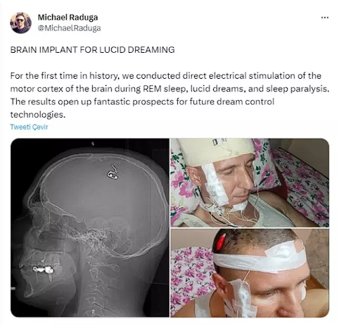 Rüyalarını kontrol etmek isteyen adam kafatasını matkapla deldi sonra da... - Resim: 2