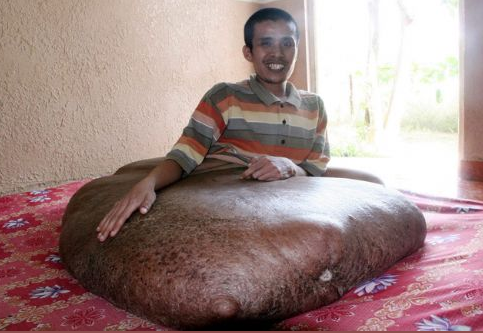 Bacağında 90 kiloluk tümör taşıyor - Resim: 2