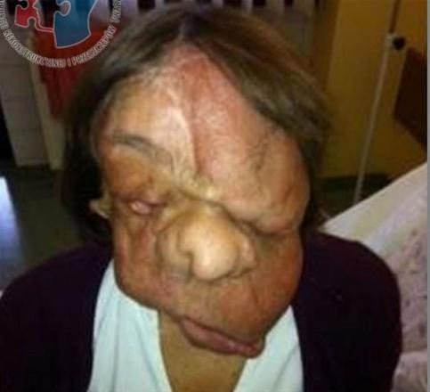 Yüz nakli sonrası inanılmaz değişim! Yok artık diyeceksiniz - Resim: 1