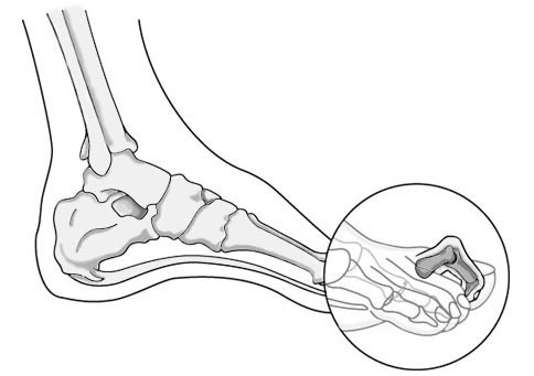 Parmaklarımızı neden çıtlatırız? - Resim: 3