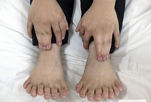 Bu çocuğun 31 tane parmağı var - Resim: 1