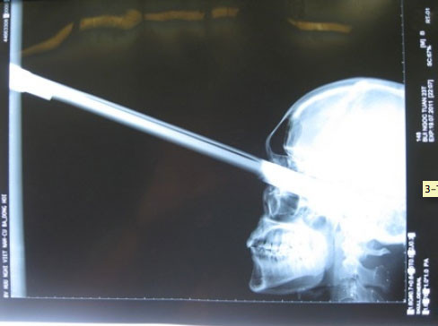 En korkunç röntgen görüntüleri - Resim: 2