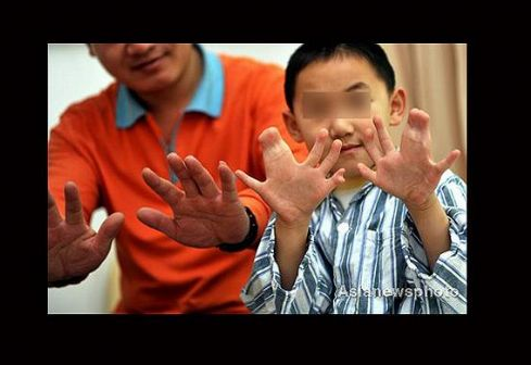 Bu çocuğun 31 tane parmağı var - Resim: 4