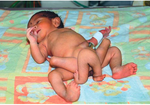 6 bacaklı bebek dehşete düşürdü - Resim: 3