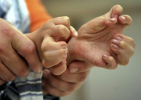 Bu çocuğun 31 tane parmağı var - Resim: 3