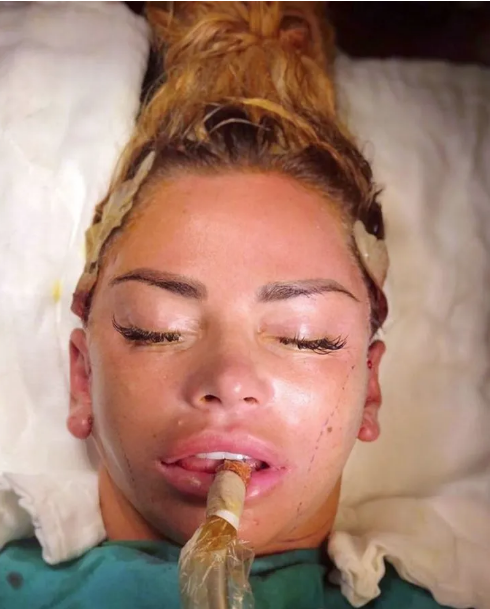 İngiliz şarkıcı Katie Price estetik ameliyatını canlı yayınladı! Sonrası ise korkunç - Resim: 4