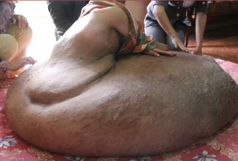 Bacağında 90 kiloluk tümör taşıyor - Resim: 1