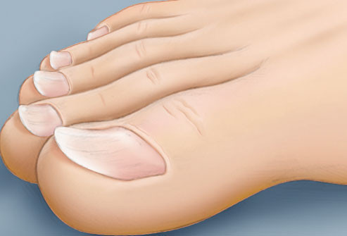 Tırnaklarınız hastalığınız söylüyor! - Resim: 4