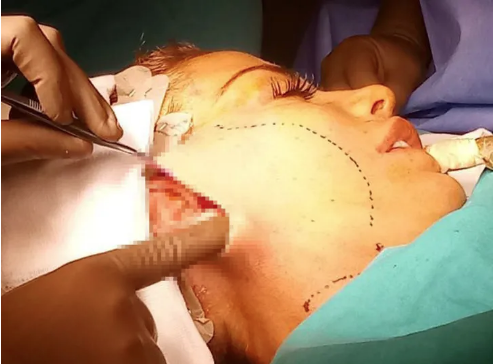 İngiliz şarkıcı Katie Price estetik ameliyatını canlı yayınladı! Sonrası ise korkunç - Resim: 3