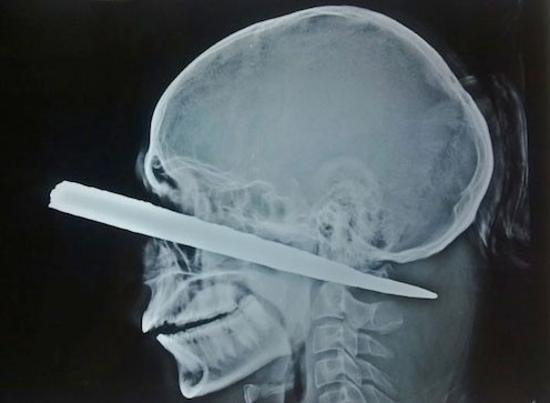 En korkunç röntgen görüntüleri - Resim: 4