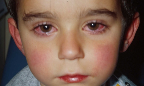 ABD'deki virüs salgınında 6 çocuk hayatını kaybetti - Resim: 3