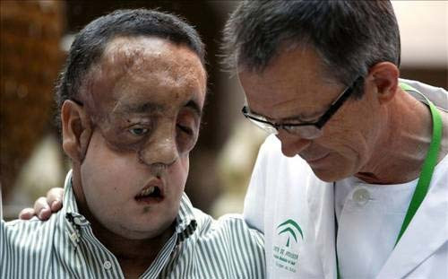 İlk tam yüz nakli - Resim: 1