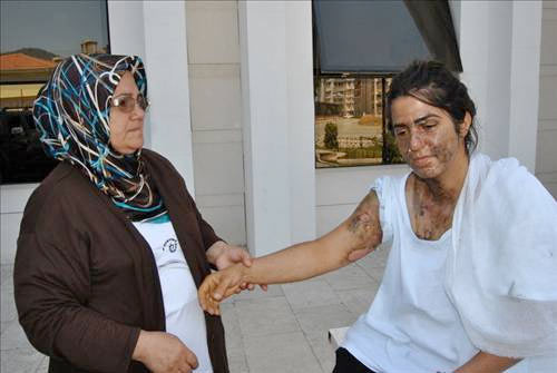 Kocası yüzüne asit döktü - Resim: 2