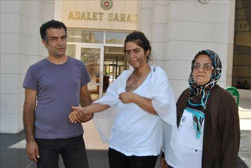 Kocası yüzüne asit döktü - Resim: 4