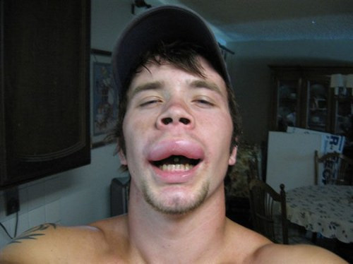 Arı sokması moda oldu! - Resim: 3