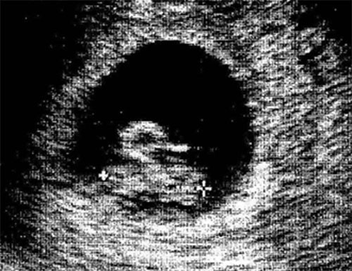 Ultrasonda bebek görüntüsü yerine çıkan şeyler - Resim: 2