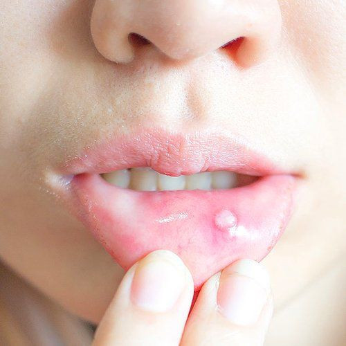 Aft nedir yemek yemeyi zorlaştırıyor sumak iyileştirir mi? - Resim: 2