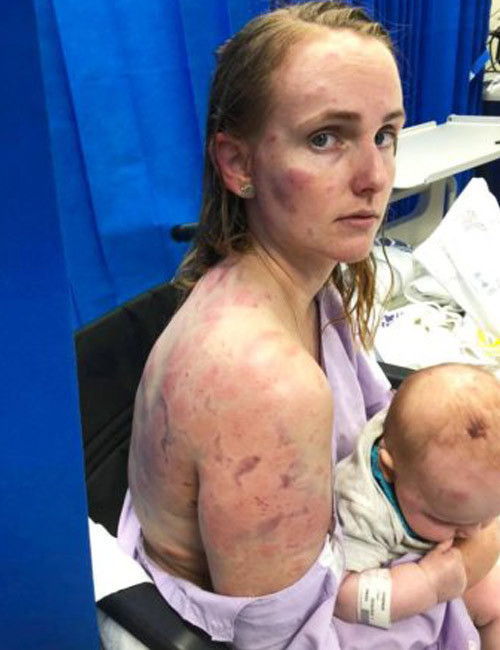 Şiddetli doluya yakalandı 4 aylık oğlunu korumak için bu hale geldi! - Resim: 2