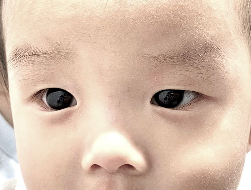 O ilacın etkisi korkuttu! Covid-19 tedavisi olan bebeğin göz rengi değişti - Resim: 0