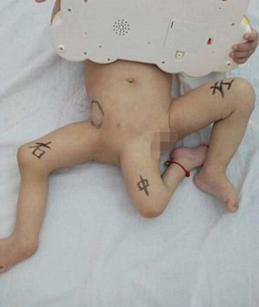 Dünyayı ayağa kaldırdı üç bacaklı çocuk kıyamet alameti gibi - Resim: 3