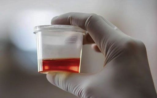 İdrardan kan gelmesi nedenleri ve tedavisi - Resim: 4