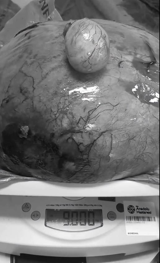 Eskişehir'de 9 kiloluk kitle şaşırttı! Hastaneye gaz şikayetiyle gitmişti - Resim: 4