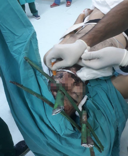 Gencin yüzüne saplanan çubuk için hastanedeki operasyona itfaiye ekibi de dahil oldu - Resim: 3