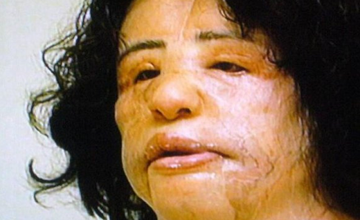 Yüzüne yemeklik yağ enjekte edince...  - Resim: 4