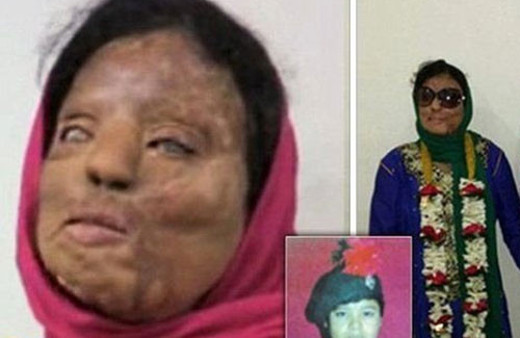 Asit saldırısına uğradı hayatı mahvoldu!