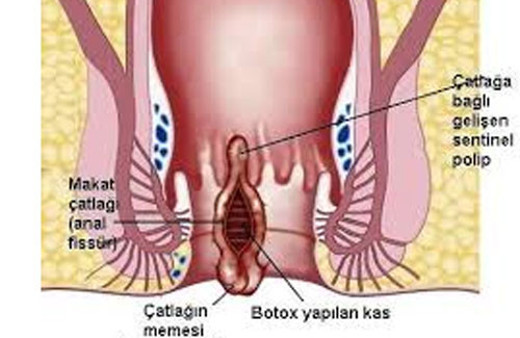 Anal fissür (Makatta çatlak ) ve  fistül nedir? Tanı ve tedavisi nasıldır?
