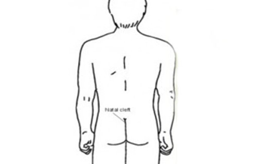 Kıl dönmesi nedir? Tedavisi nasıldır?