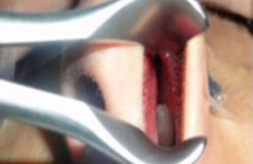 Burnundan diş çıktı ağzında ise...